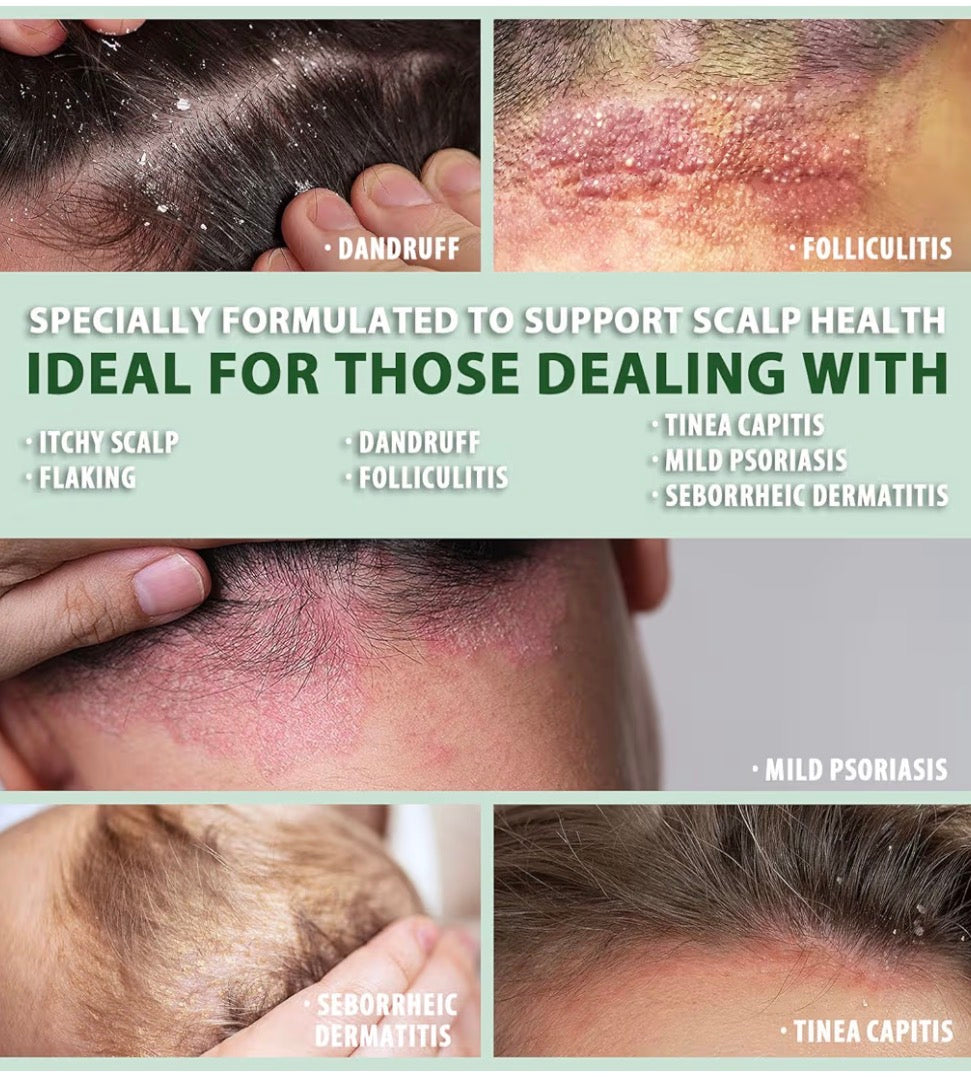 Psoriasis & Folliculitis Scalp Treatment Shampoo: Seborrheic Dermatitis Formula, Anti-Dandruff, Itchy and Dry Scalp Care with Salicylic Acid, Piroctone Olamine, Biotin, Rosemary, Coconut Oil
